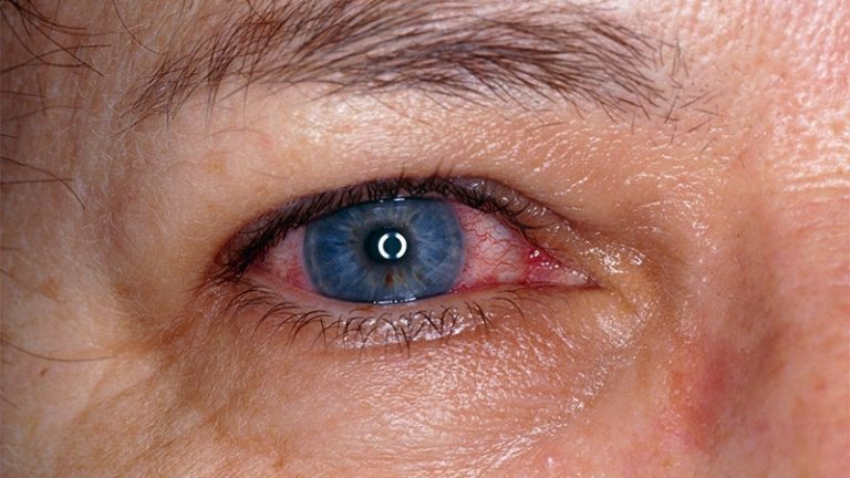 Spondyloarthritis May Go Undiagnosed in Many With Uveitis - UWINHEALTH