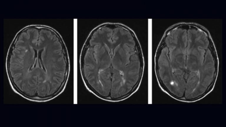 can-ms-be-stopped-early-in-its-tracks-uwinhealth