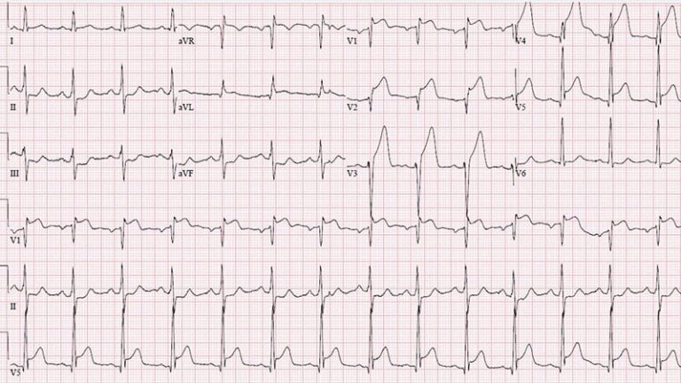 Half-dose TNK for STEMI Without Timely PCI: STREAM-2 - UWINHEALTH